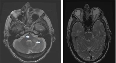 Clinical Characteristics and Etiology of Bilateral Vestibular Loss in a Cohort from Central Illinois